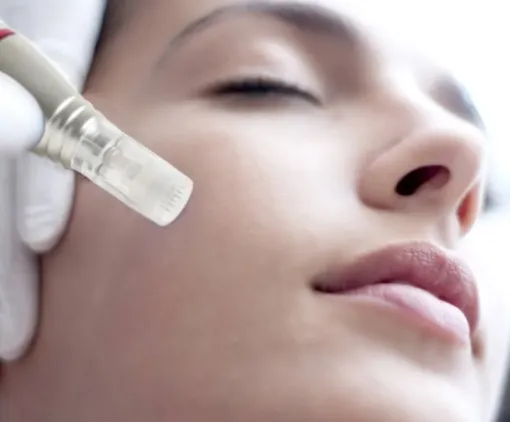 Séance de microneedling pour traiter le vieillissement cutané à Lyon 02, Lyon, L'Embellie - Centre de Beauté