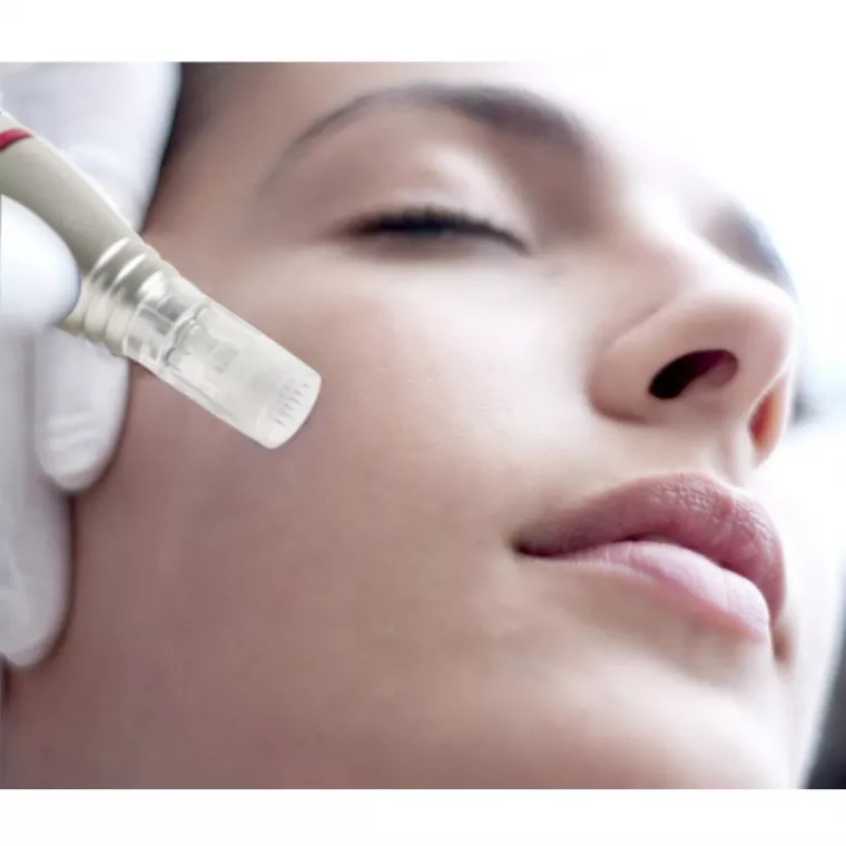 LE MICRONEEDLING : la technique, Lyon, L'Embellie - Centre de Beauté