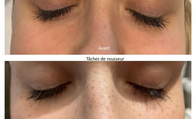 Tâches de rousseurs en dermopigmentation 55€ , à Lyon 2ème, Lyon, L'Embellie - Centre de Beauté