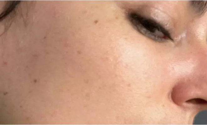 Dermo-pigmentation : tâches de rousseurs avant/ après, Lyon, L'Embellie - Centre de Beauté