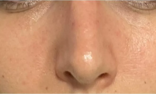 Dermo-pigmentation : tâches de rousseurs avant/ après, Lyon, L'Embellie - Centre de Beauté