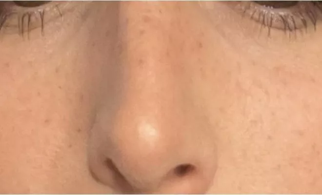 Dermo-pigmentation : tâches de rousseurs avant/ après, Lyon, L'Embellie - Centre de Beauté