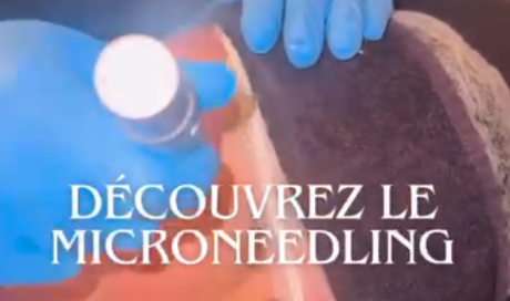 Séance de microneedling visage dans votre centre de beauté à Lyon 
