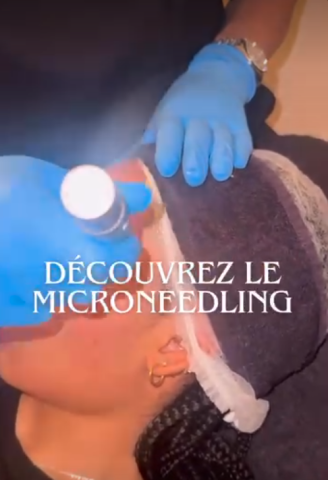 Séance de microneedling visage dans votre centre de beauté à Lyon 
