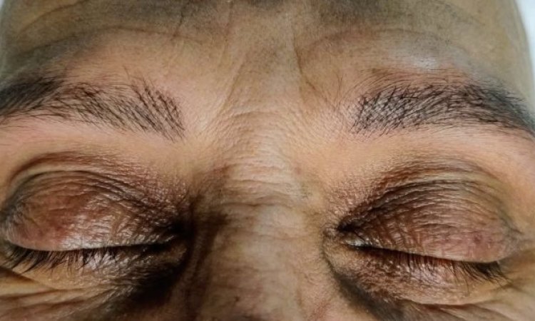 +30MN APRES MICRONEEDLING 